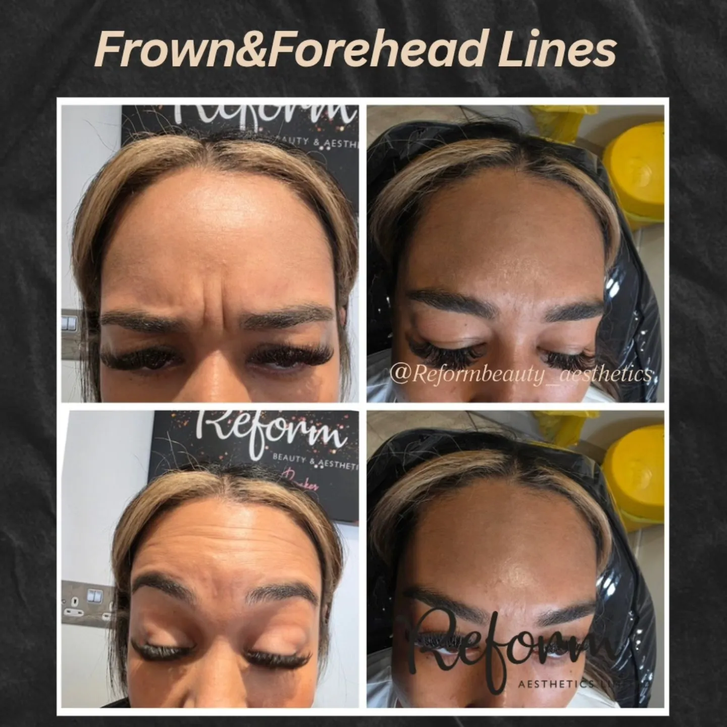 A collage of photos of a woman's face with eyebrows and forehead lines.
